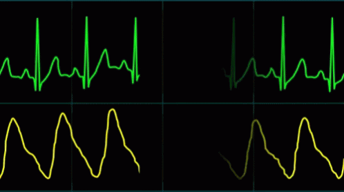 Gif of EKG signal
